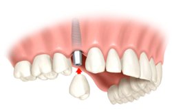 Zubní implantát IMPLADENT
